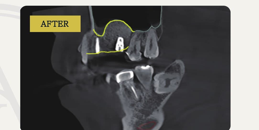 상악동 거상술 후 X-RAY