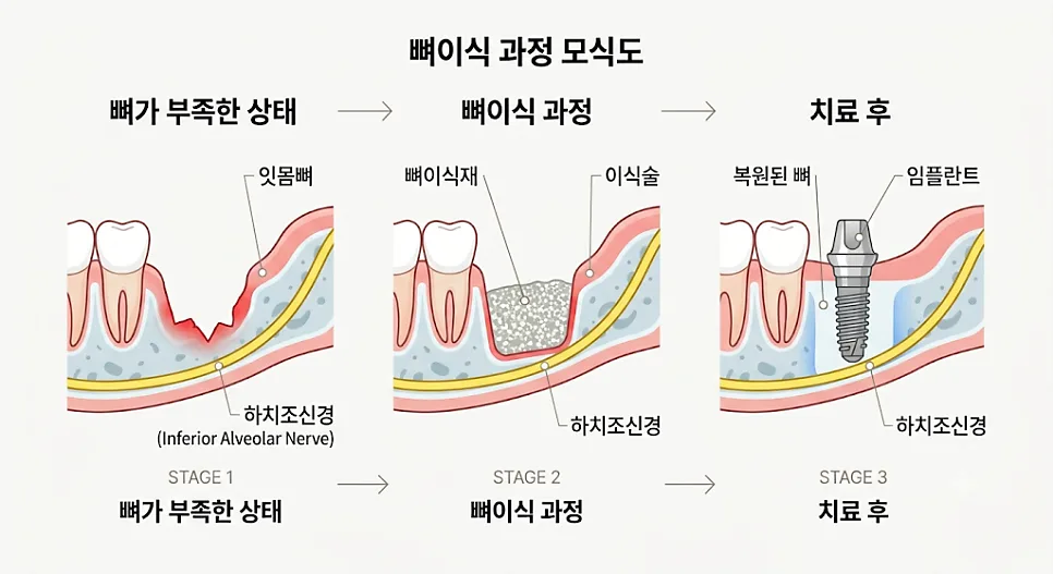 송도임플란트 뼈이식이 필요한 경우와 상악동 거상술 안내 관련 사진 2