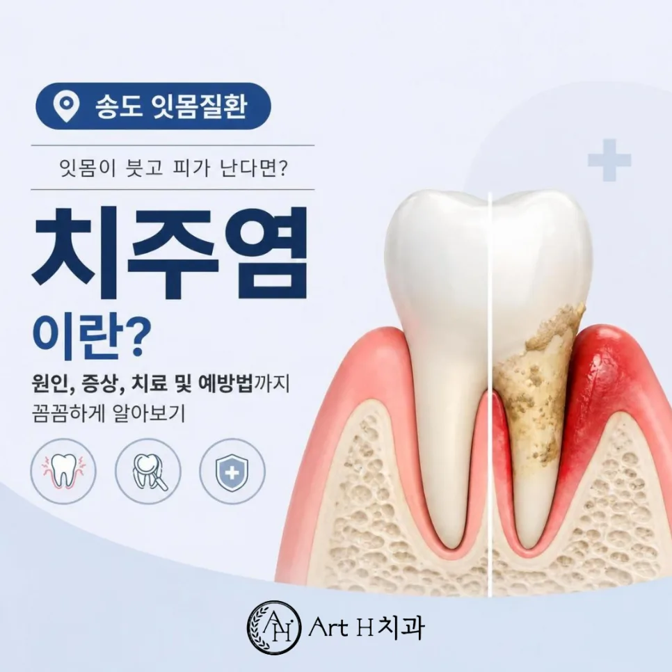 송도 양치할 때 잇몸 출혈, 치은염과 치주염 단계별 잇몸치료 관련 사진 1