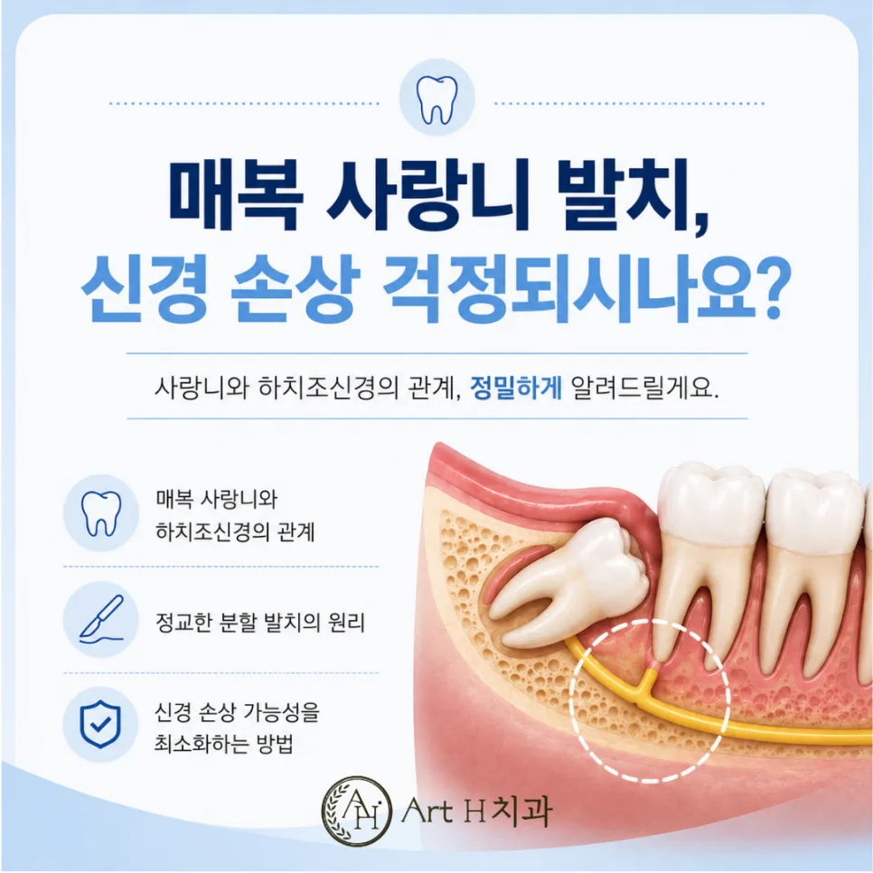 송도 매복 사랑니 발치와 하치조신경, 신경 손상 위험 바로 알기 관련 사진 1