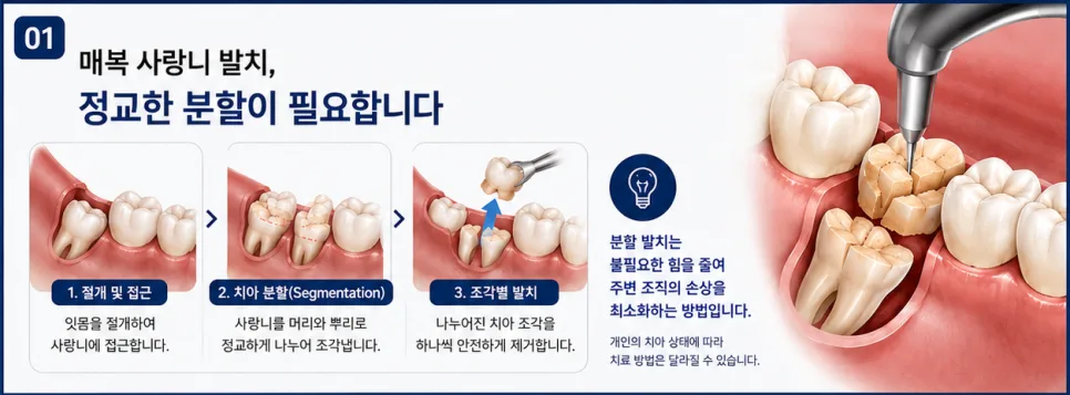 송도 매복 사랑니 발치와 하치조신경, 신경 손상 위험 바로 알기 관련 사진 3