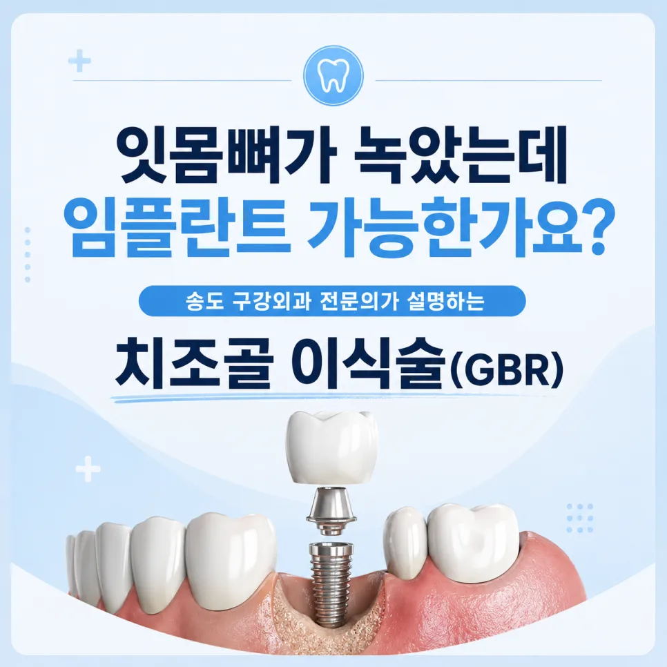 잇몸뼈가 녹았을 때 임플란트, 송도 치과의 골이식술(GBR) 안내 관련 사진 1