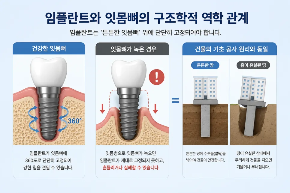 잇몸뼈가 녹았을 때 임플란트, 송도 치과의 골이식술(GBR) 안내 관련 사진 2