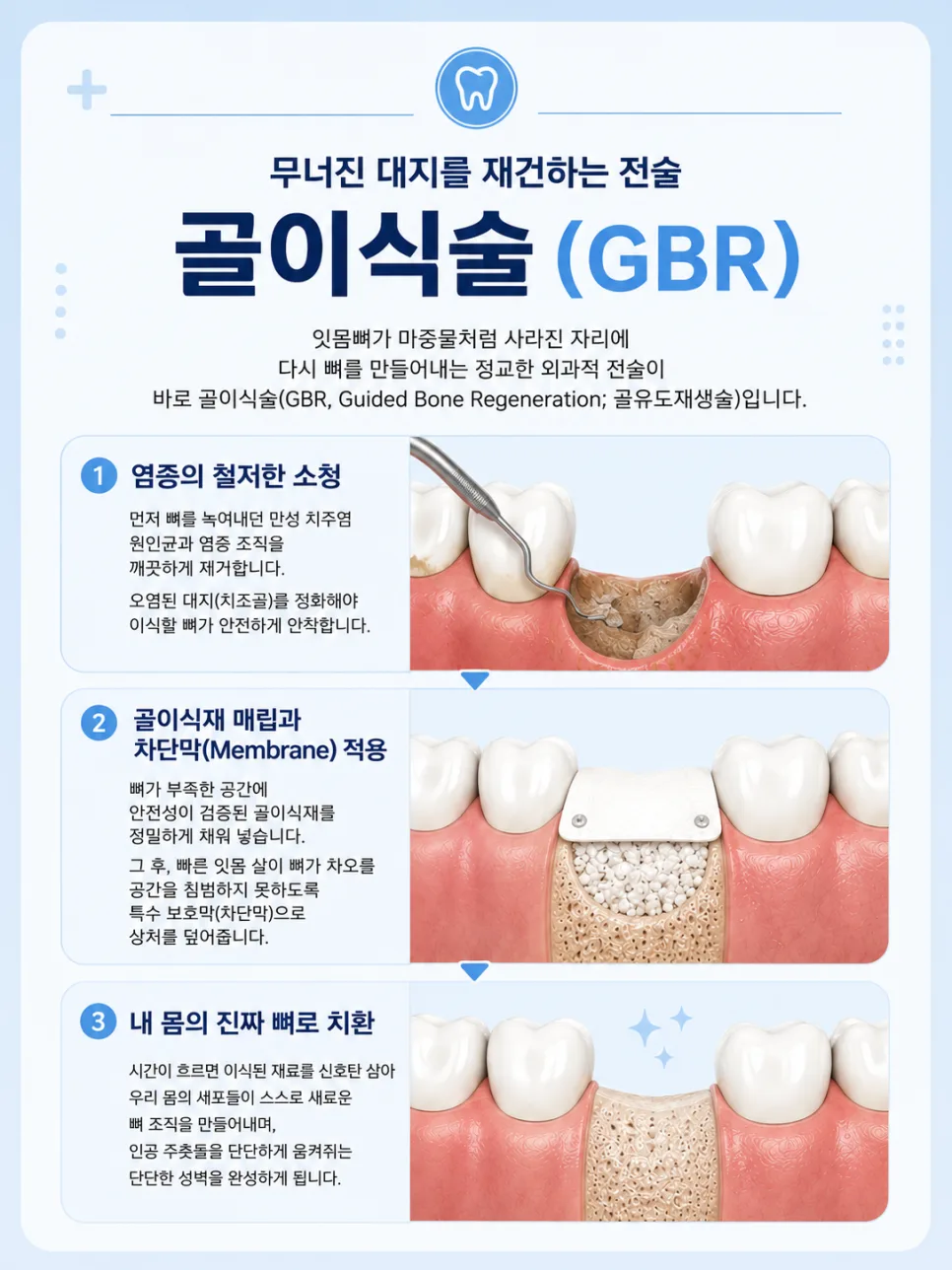 잇몸뼈가 녹았을 때 임플란트, 송도 치과의 골이식술(GBR) 안내 관련 사진 3