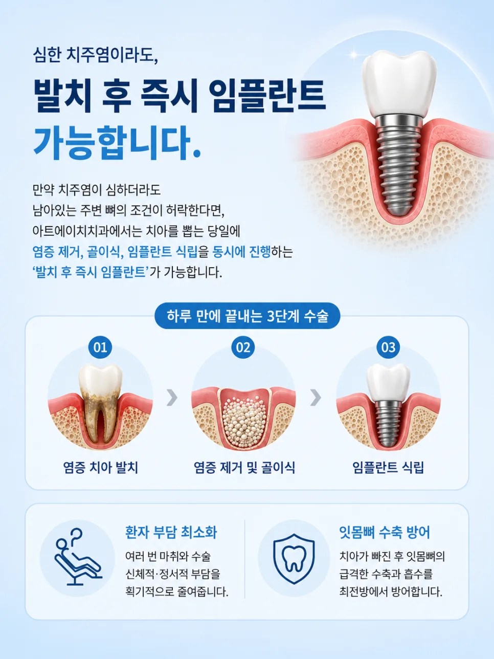 잇몸뼈가 녹았을 때 임플란트, 송도 치과의 골이식술(GBR) 안내 관련 사진 4