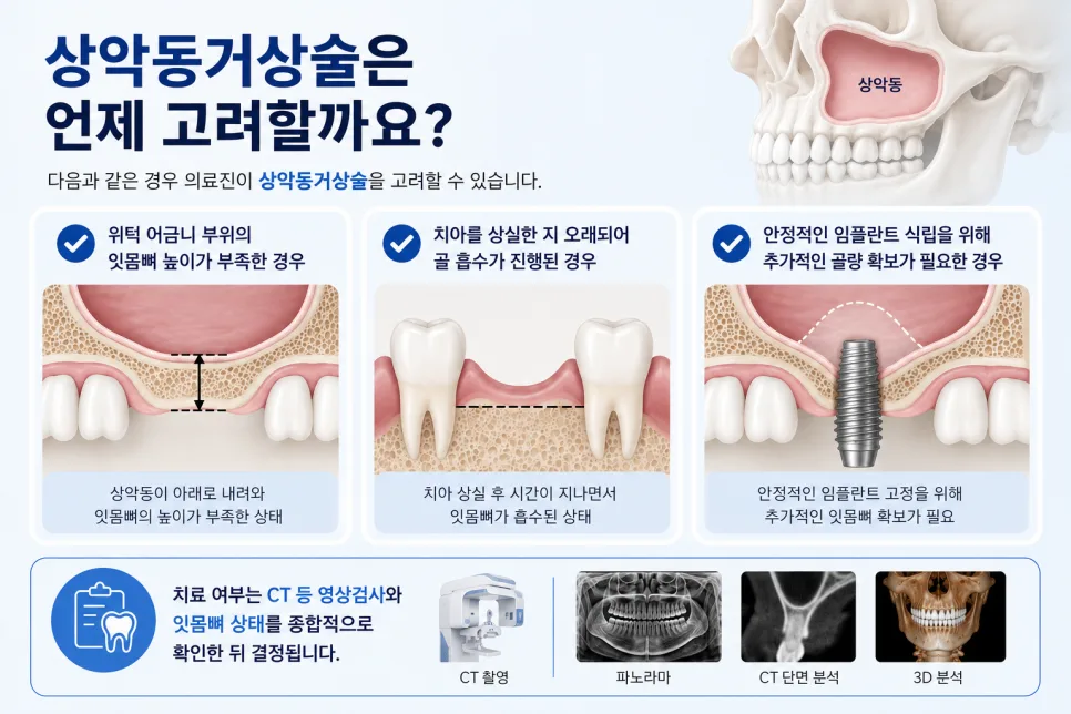 송도치과 상악동거상술과 뼈이식, 임플란트 전 필요한 경우 안내 관련 사진 2
