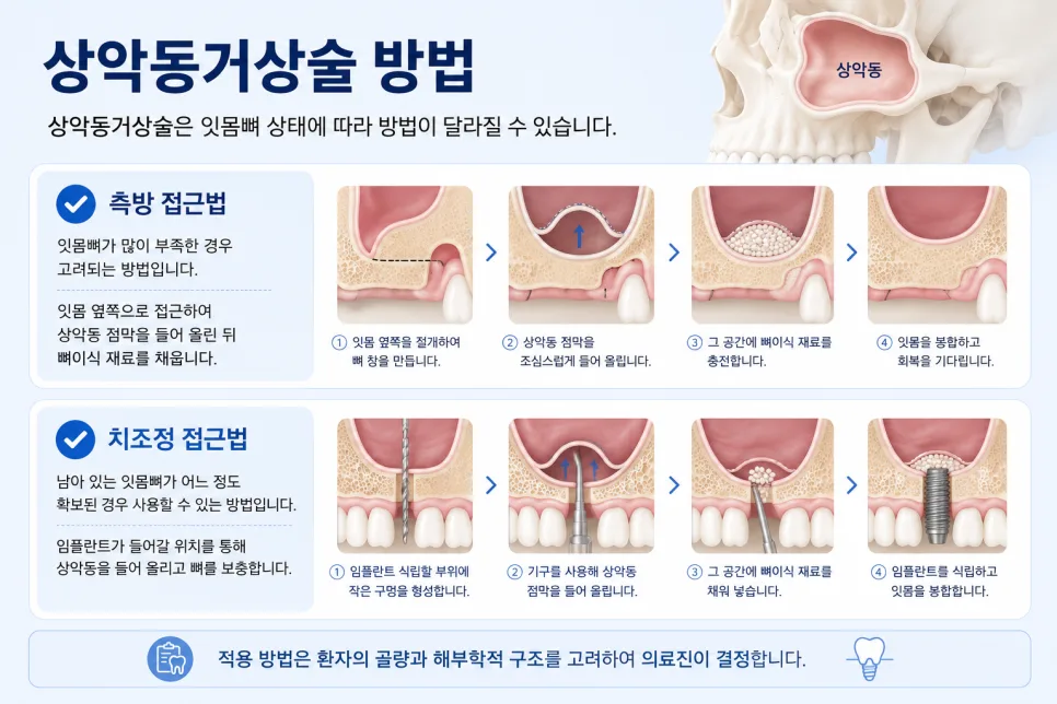 송도치과 상악동거상술과 뼈이식, 임플란트 전 필요한 경우 안내 관련 사진 3