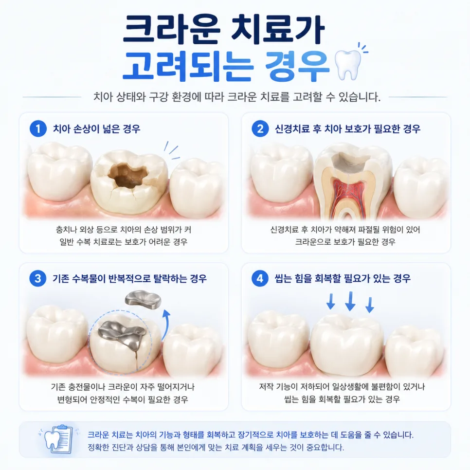 송도치과 신경치료와 크라운, 자연치아를 살리는 치료 과정 안내 관련 사진 3