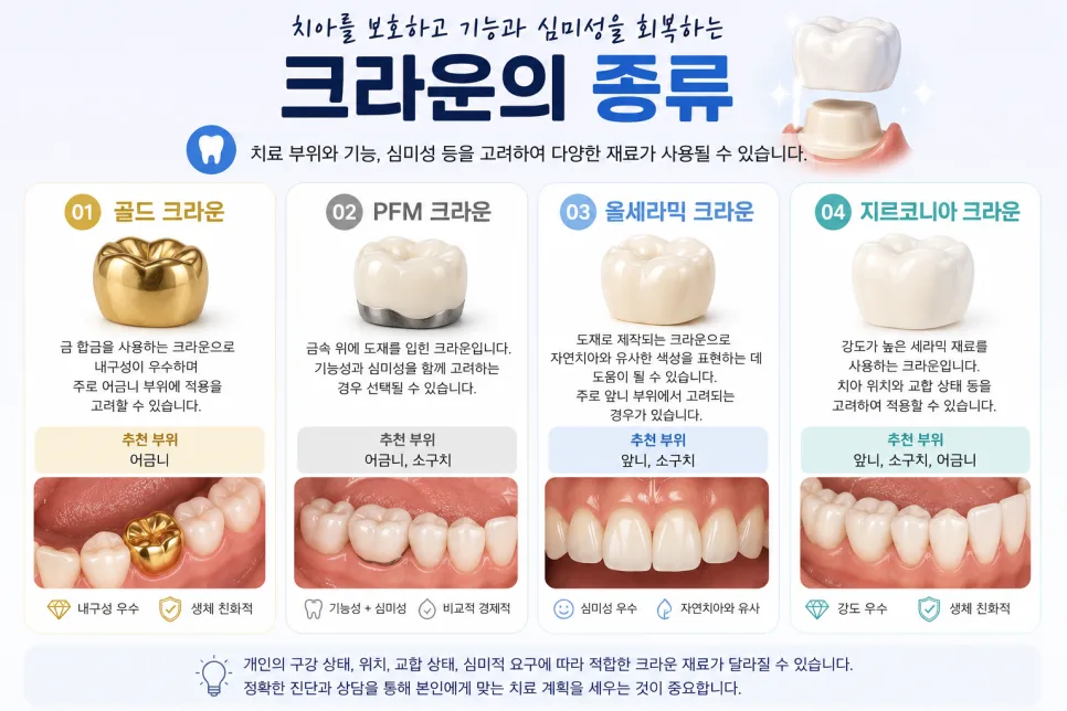 송도치과 신경치료와 크라운, 자연치아를 살리는 치료 과정 안내 관련 사진 4