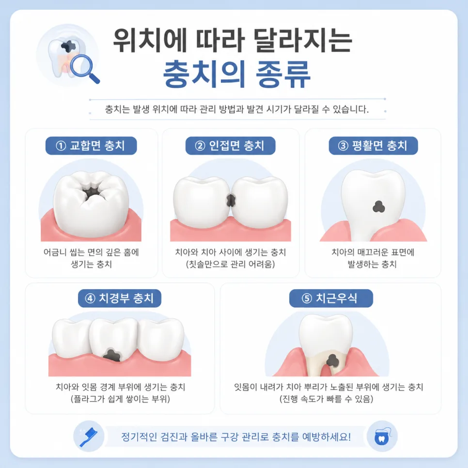 연수역 치과 충치란 무엇인가요, 종류와 증상 그리고 예방법 관련 사진 2