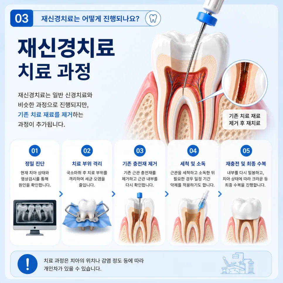 국제업무지구역 재신경치료, 필요한 경우와 치료 과정 안내 관련 사진 4