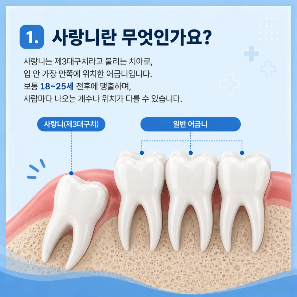 송도동 치과 사랑니, 발치를 고려하는 경우와 발치 후 관리 관련 사진 2