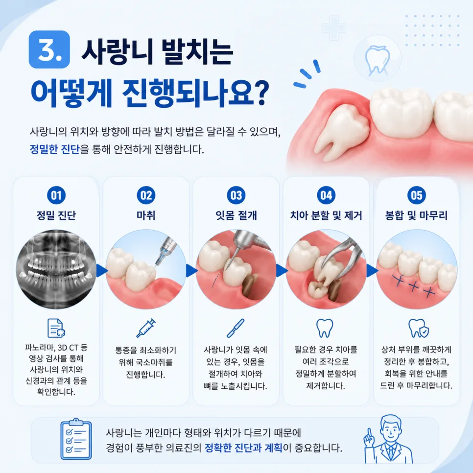 송도동 치과 사랑니, 발치를 고려하는 경우와 발치 후 관리 관련 사진 4