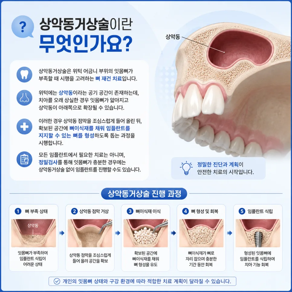 송도 상악동거상술, 위턱 잇몸뼈가 부족해도 임플란트가 가능한 이유 관련 사진 2