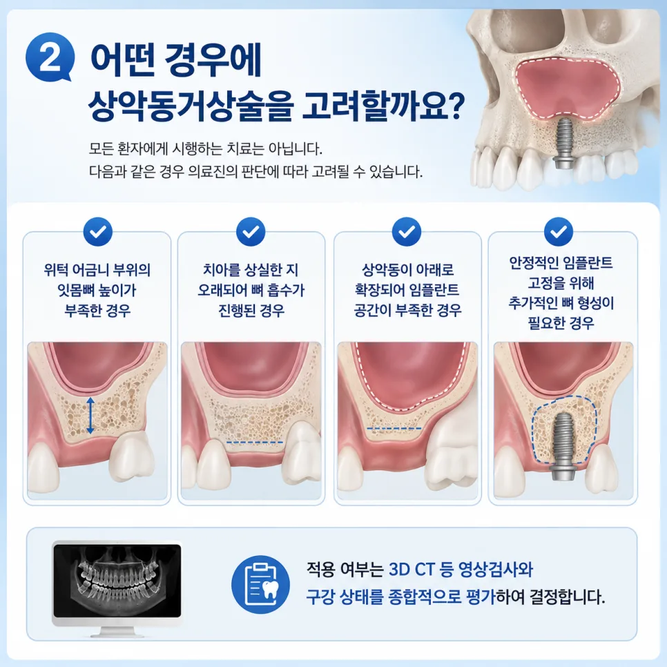 송도 상악동거상술, 위턱 잇몸뼈가 부족해도 임플란트가 가능한 이유 관련 사진 3