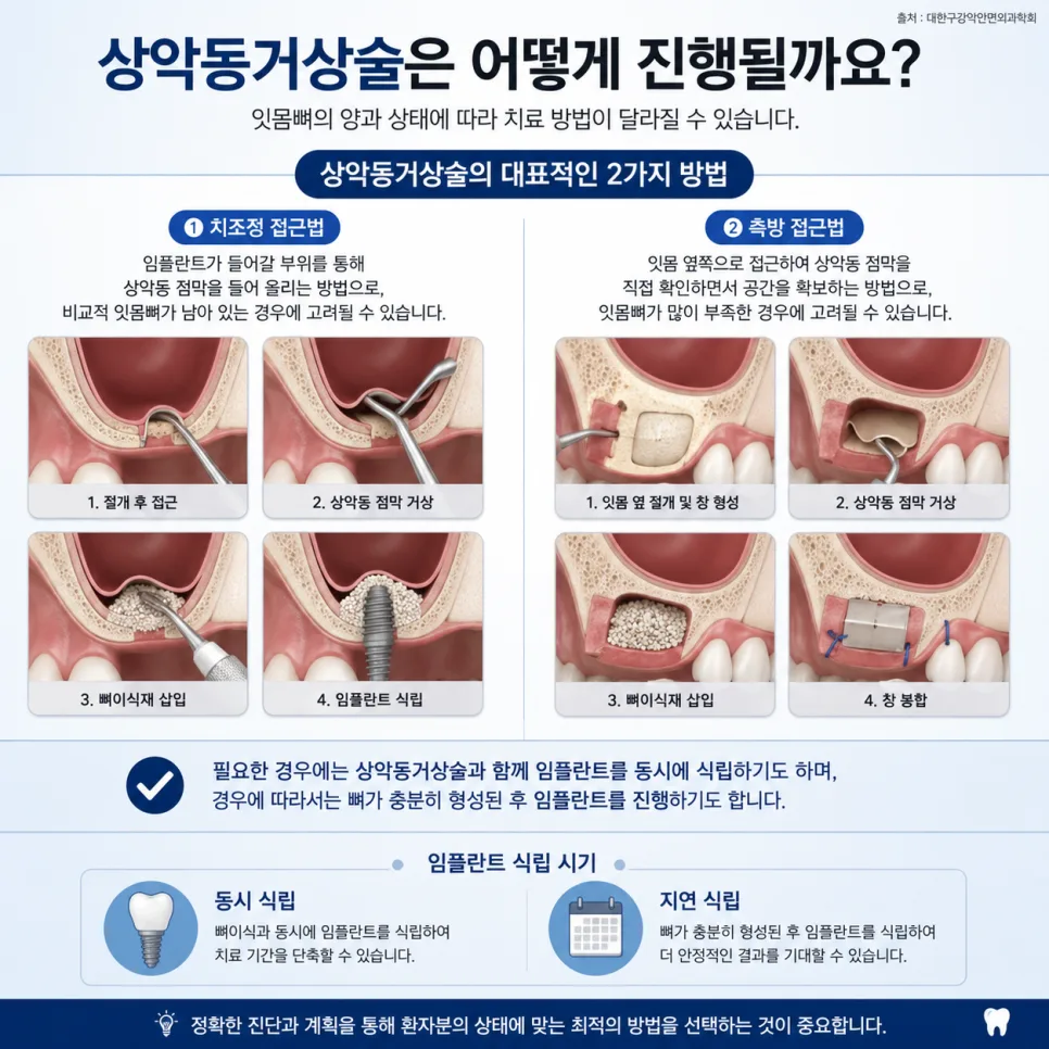 송도 상악동거상술, 위턱 잇몸뼈가 부족해도 임플란트가 가능한 이유 관련 사진 4